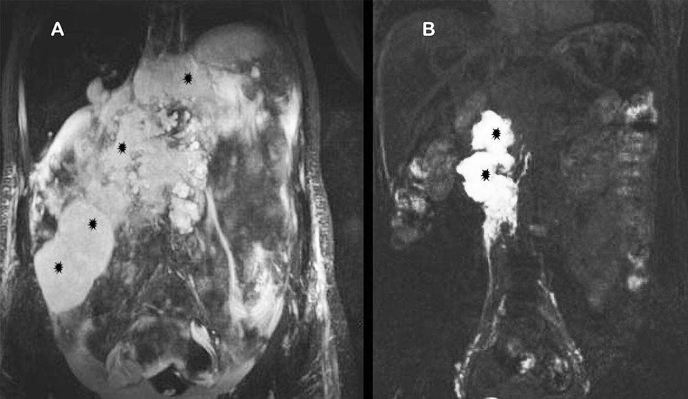 Image demonstrates coronal MR sequence following injection of contrast through bilateral inguinal lymph nodes